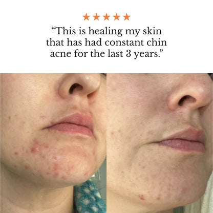 The Complete Acne System for Women